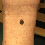 A lesion without dermatoscopy at Hamilton Skin Cancer Centre