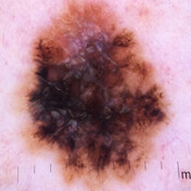 A lesion with dermatoscopy at Hamilton Skin Cancer Centre