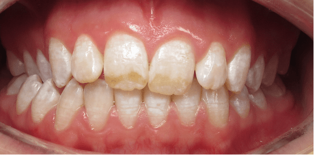 Before Resin Inf. with the brown spots and mottling