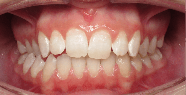 After at-home bleaching with 10% carbamide peroxide for 4 weeks and resin infiltration