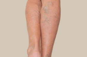 Bruising & Varicose Veins