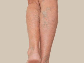 Bruising & Varicose Veins
