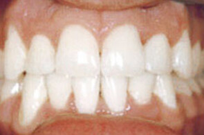 After FastBraces® treatment
