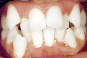 Before FastBraces® treatment