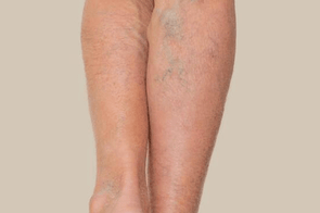 Bruising & Varicose Veins