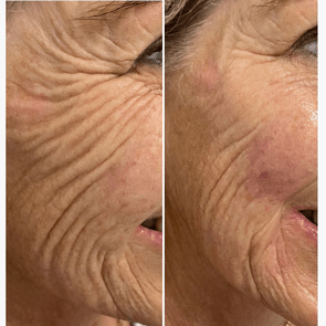 Dermal Filler - Cheeks & Lower Face