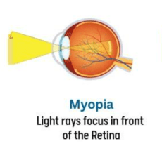Myopia, Presbyopia, and Finding the Right Lens for Your Vision