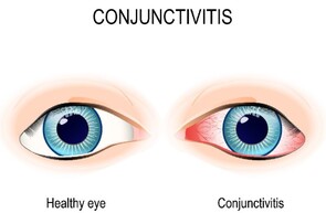 Eye Infections