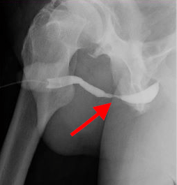 Urethrogram - Demonstrating urethral stricture