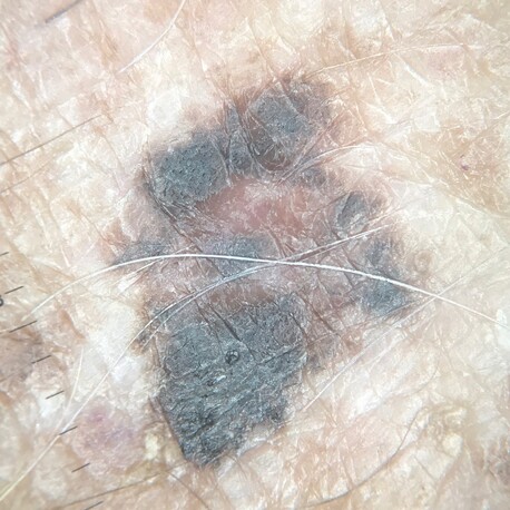Non-polarised image – Melanoma