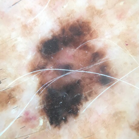 Polarised image – Melanoma