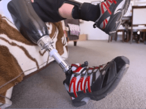 Significant Rise in Amputations for Kiwis with Diabetes