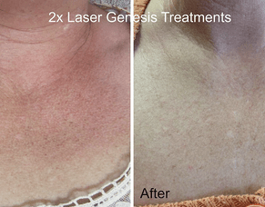 Before & After - Laser Genesis