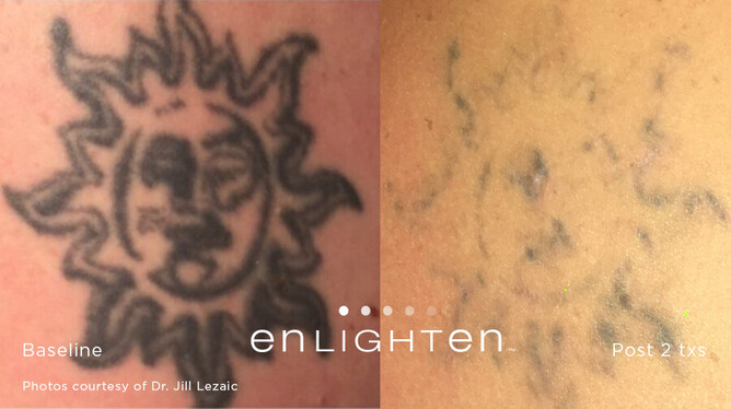 The latest laser tattoo removal technology now available here in Pukekohe!  | Harleh Laser Clinic Pukekohe