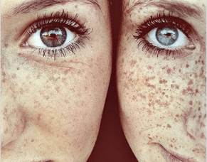 What you need to know about pigmentation and how to treat it.