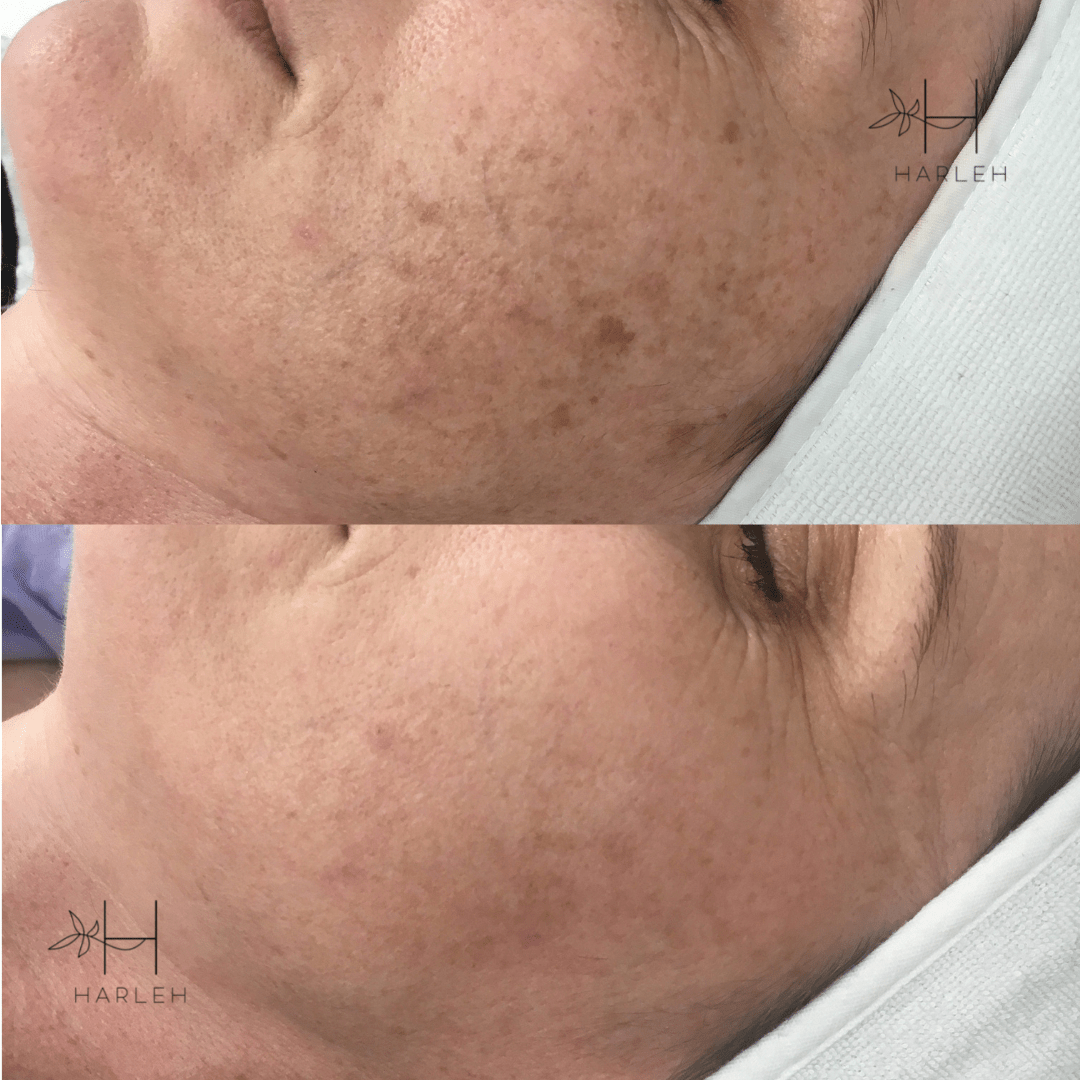 Pico Genesis Laser before and after Harleh Laser Clinic Pukekohe