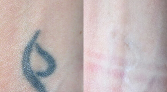 Tattoo Removal Princeton - Princeton Aesthetics