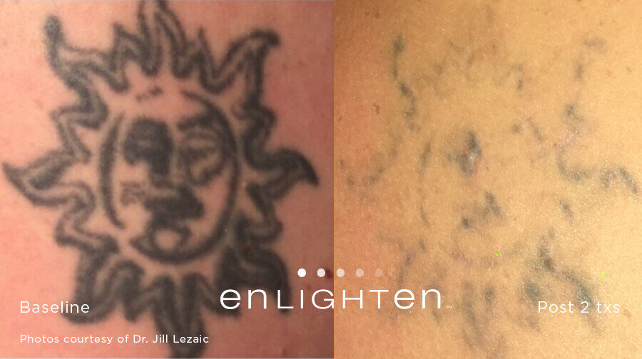 Laser Smart Tattoo Removal