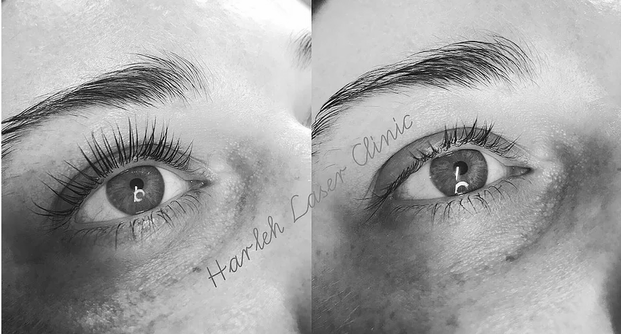 yumi lash lift Harleh Laser Clinic