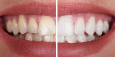 Teeth whitening