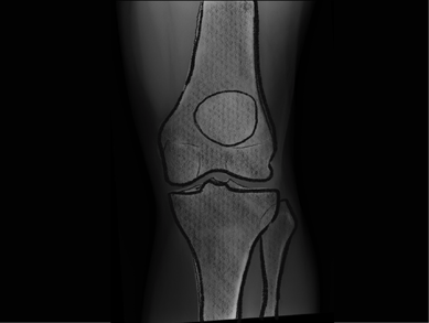 X-ray illustration of a human knee joint, showing detailed outlines of the femur, tibia, and patella, against a dark background.