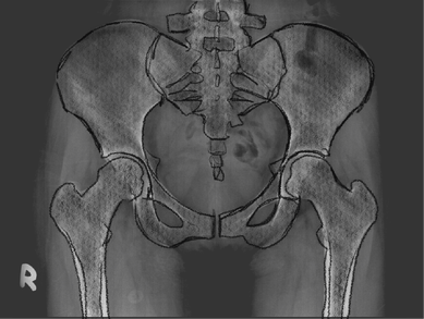 X-ray illustration of a human pelvis and hip bones, showing detailed outlines of the skeletal structure, including the femur and pelvis, against a dark background.