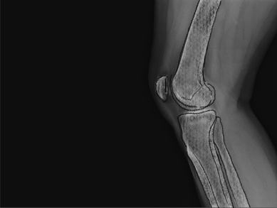 X-ray illustration of a side view of a human knee joint, showing the femur, tibia, and patella, against a dark background.
