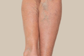 Bruising & Varicose Veins