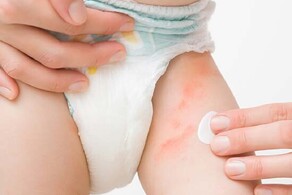 Nappy Rash