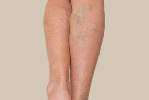 Bruising & Varicose Veins