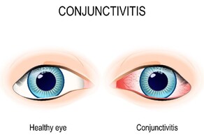 Eye Infections
