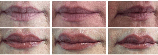 LIP ENHANCEMENT
