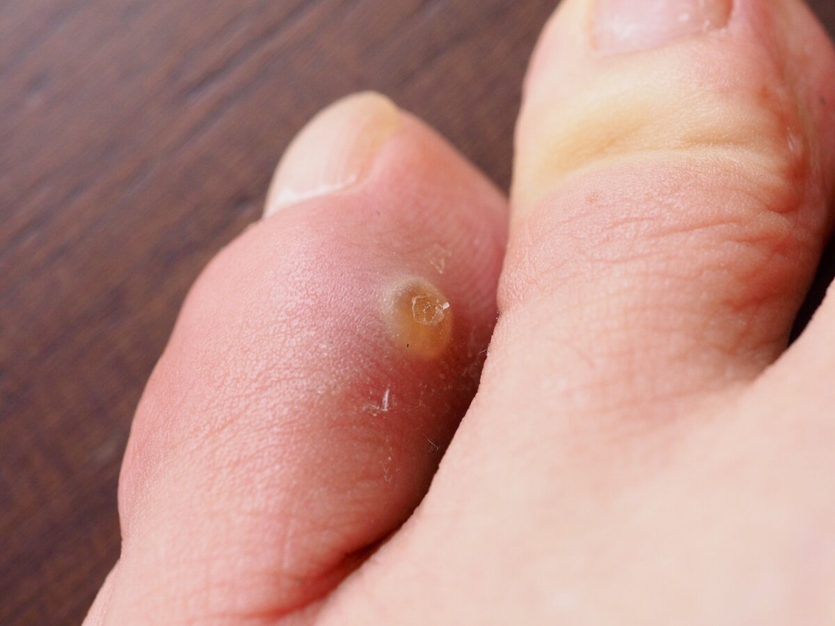 Painful corn between toes online