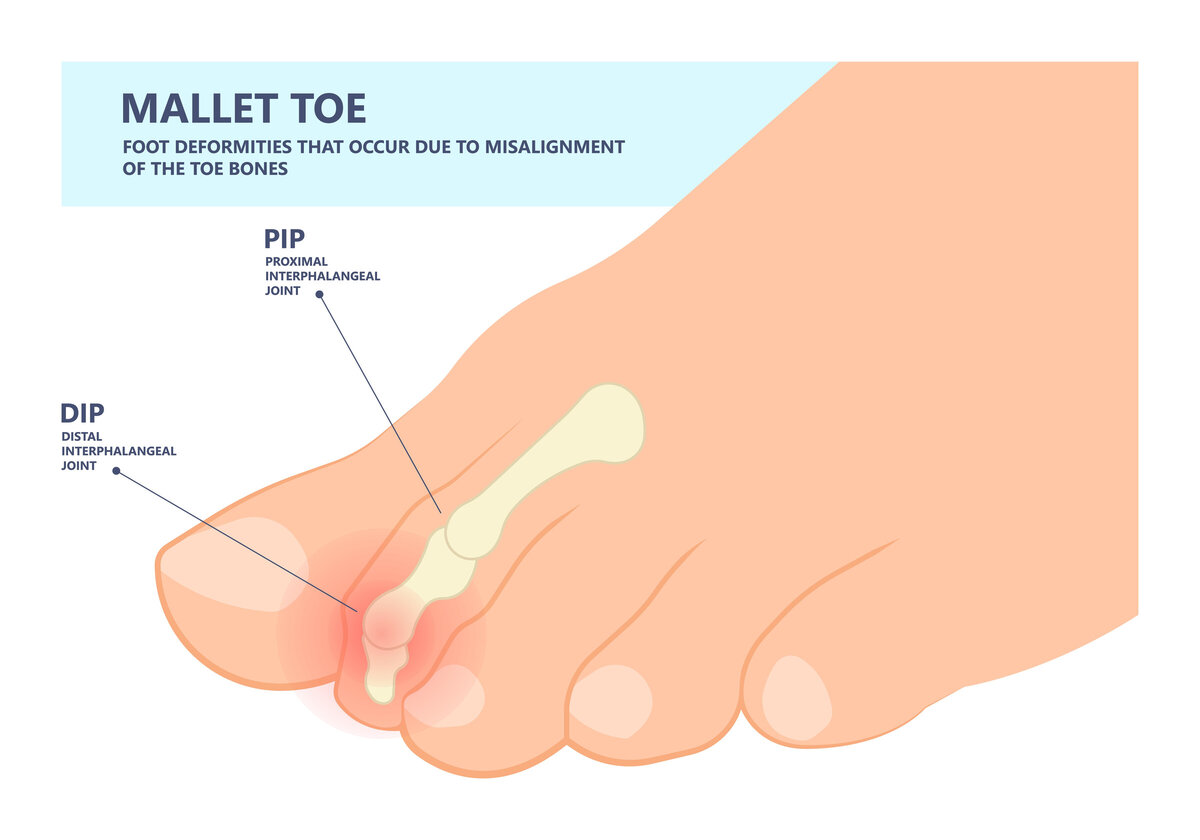 Mallet Toes The Foot Place
