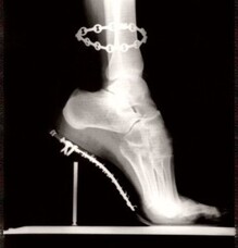 High Heel shoe dangers