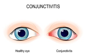 Eye Infections