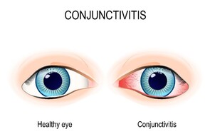 Eye Infections