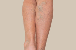 Bruising & Varicose Veins