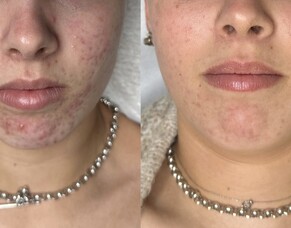 Acne - a tough one to treat (but not here)