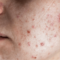 Understanding Inflamed Acne: Causes, Triggers, and Treatment