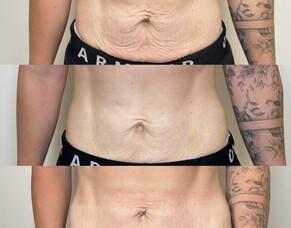 HIFU - Your surgery free facelift or body sculpting system