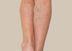 Bruising & Varicose Veins