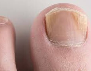 Fungal Nail Infection Treatment NZ | Foot Foundation Podiatrists