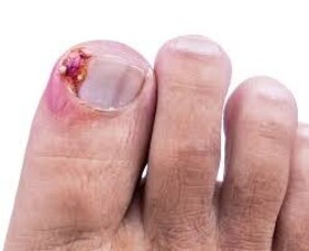 Expert Ingrown Toenail Surgery At Foot Foundation