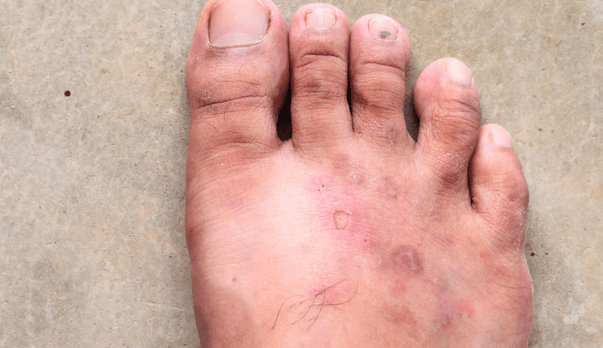 How to Manage Foot Skin Conditions Effectively