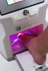 Cold Laser Treatment for Fungal Nail Infections (Lunula Laser)