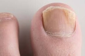 Understanding Fungal Nail Infections and Effective Treatments