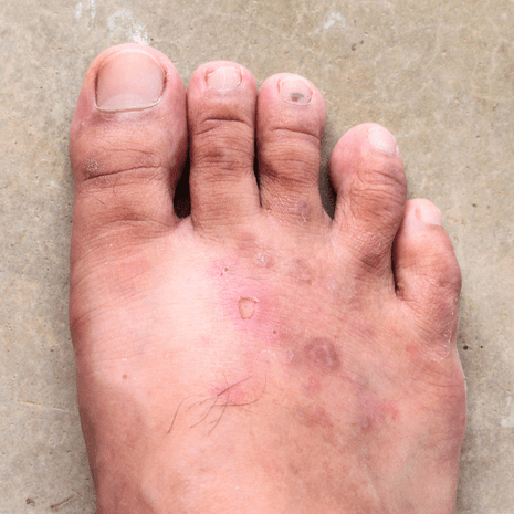 Specialist podiatry care for foot skin conditions including corns, calluses, warts, athlete’s foot, cracked heels, and dermatitis at Foot Foundation