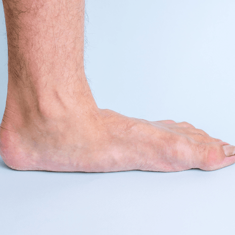 Foot Foundation podiatry treatment for flat feet with orthotics, footwear support, and rehabilitation