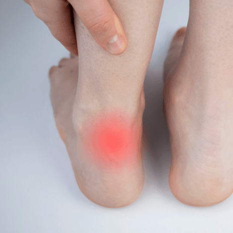 Foot with Achilles tendon pain highlighted in red, treated at Foot Foundation